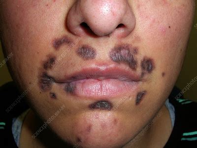 Discoid lupus erythematosus - Stock Image - C056/5441 - Science Photo ...