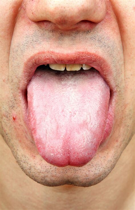 Yeast Infection On Tongue Treatment