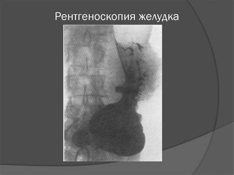 Язвенная болезнь желудка и двенадцатиперстной кишки - презентация онлайн