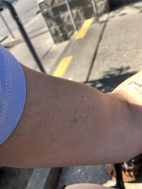 help!! why am i bruising after working out?? i don’t know if i’m over