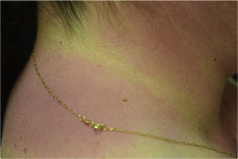Erythematous rash located in photo-exposed areas: choker area is ...