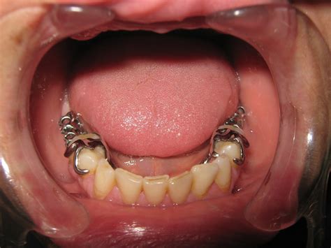 Partial Denture Clasps