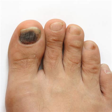 Thickening Toenails Worried About LO's Thick Toenail : R/toddlertips