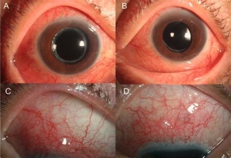 Toxocara Canis Eye