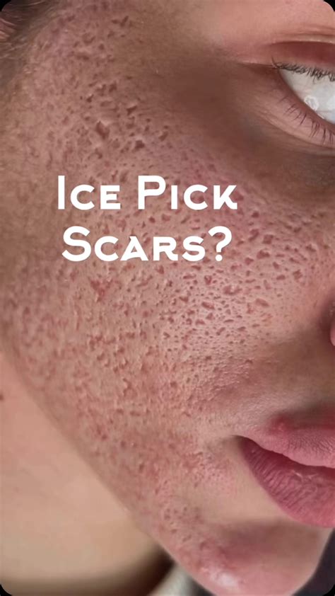 how to get rid of peely skin 8