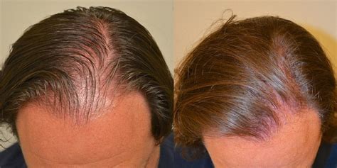 Finasteride Tablets | Risks, Side Effects & Dosage