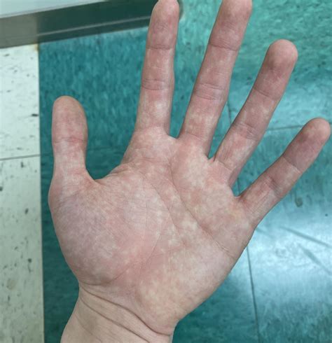 Why do hands get splotchy like this? | Scrolller