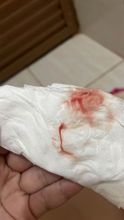 Sangramento De Nidação Pode Ser Vermelho Vivo - Sangramento de ovulação? Ou Nidacao? | BabyCenter