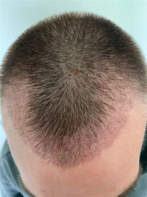 hair plug before and after 2