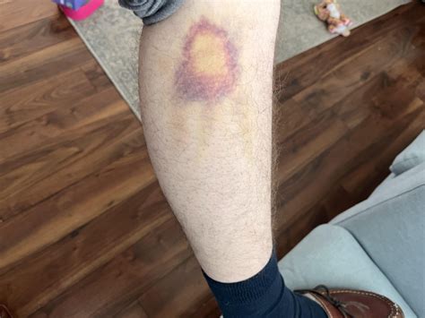 The way my bruise is healing. : r/mildlyinteresting