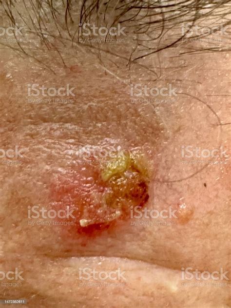Squamous Cell Carcinoma On Human Forehead Stock Photo - Download Image ...