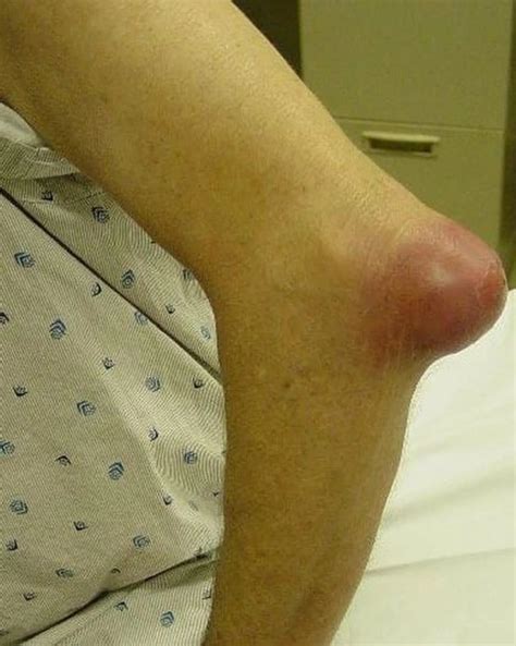 Mild Olecranon Bursitis