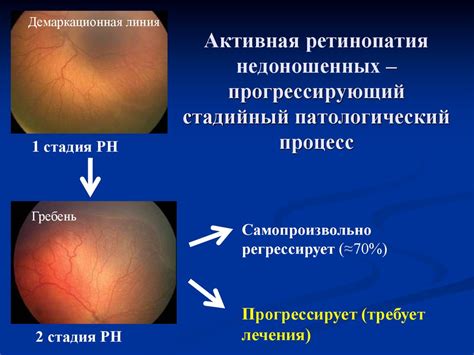 Ретинопатия у новорожденных - презентация онлайн