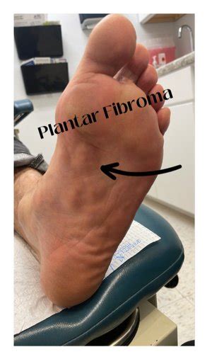 Plantar Fibromas — LIGHTHOUSE FOOT & ANKLE CENTER