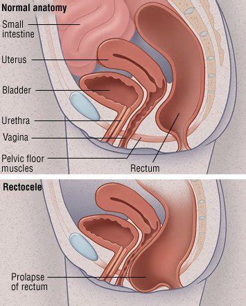 Prolapse Symptoms Of Floor Weakness - Carpet Vidalondon