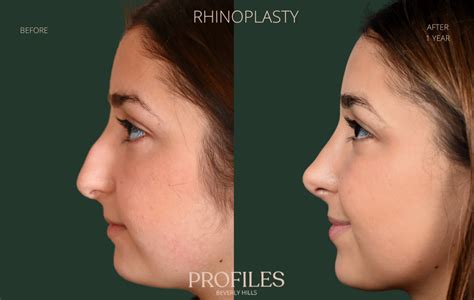 nose job    front  mary loomis blog