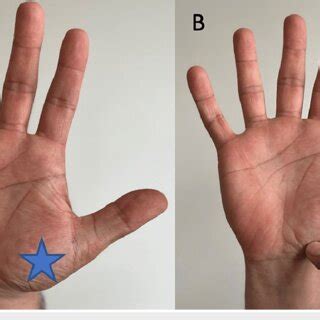 First carpometacarpal joint (A) Location of the first carpometacarpal ...