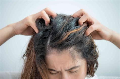 how to tell if you have dandruff or lice