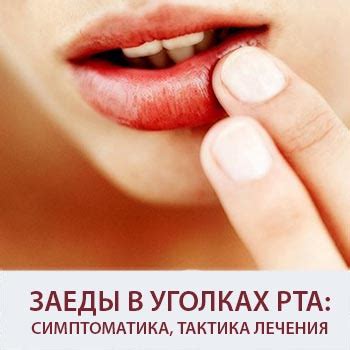 Читайте: Заеды в уголках рта: симптоматика, тактика лечения