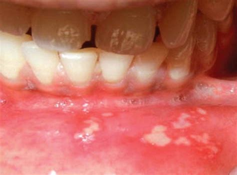 Aphthous Ulcer - Pictures, Home Remedies, Causes, Treatment