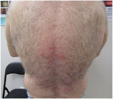 mid    months  treatment  scientific diagram