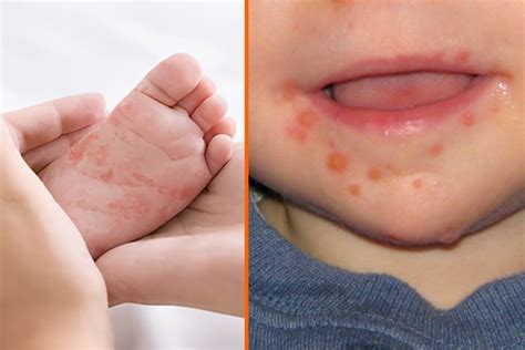 Virus Coxsackie presente en Hidalgo y Puebla | Tips de Salud