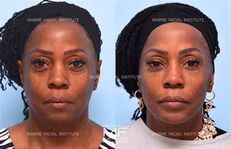 Complete Facial Rejuvenation or Contouring Before and After Pictures