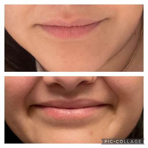 TMJ botox regrets : r/TMJ