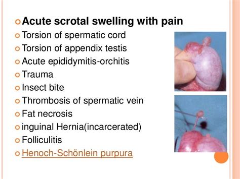 Acute scrotal swelling and pain in children1