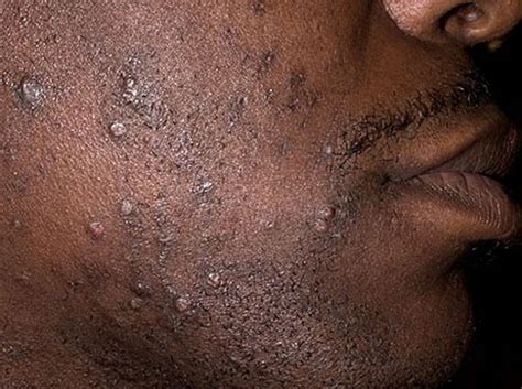 pelos encarnados en la barba trastornos de la piel manual msd