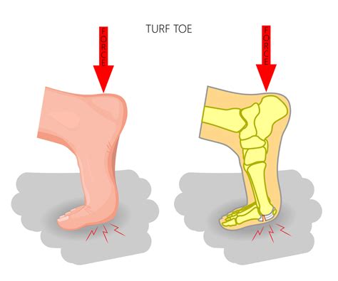 Turf Toe Causes & Symptoms – My FootDr
