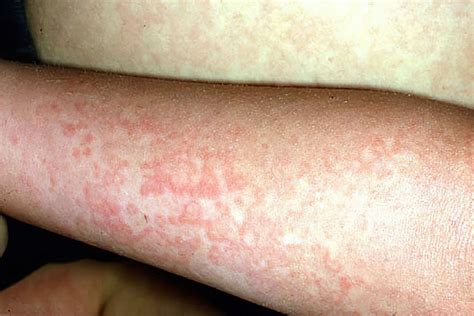 Fifth Disease: Symptoms, Causes, Treatment, And More, 40% OFF