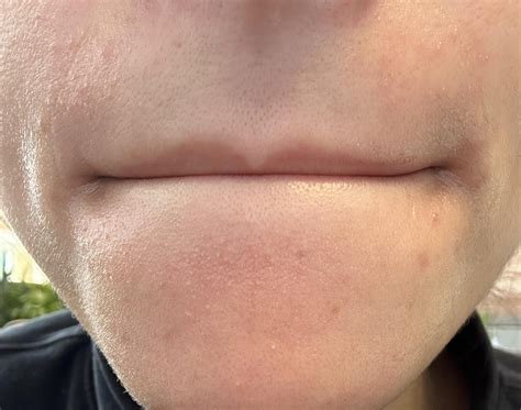 What are these white bumps near my mouth? And how to make them go away