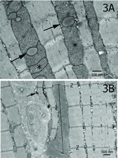 (A) Electron micrograph showing hyperplastic mitochondria with ...