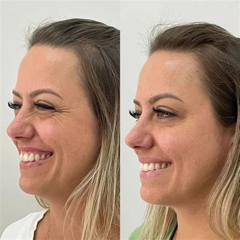 Botox No Queixo Antes E Depois
