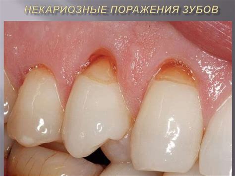 Некариозные поражения зубов - online presentation