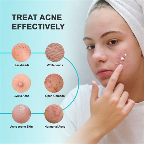 Showdown: 10% Azelaic Acid vs. Multi-Spot Use for Hormonal Acne - Teens