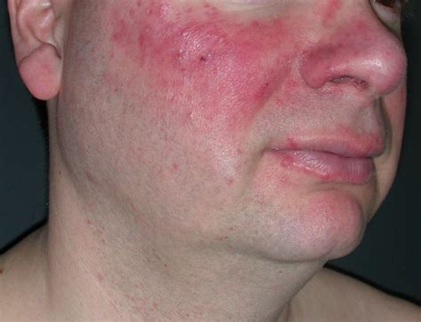 Skin Care Products May Reduce Incidence of Rosacea in Patients With ...