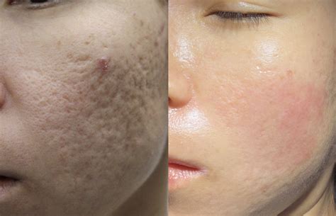 laser treatment  pores  face cost philippines