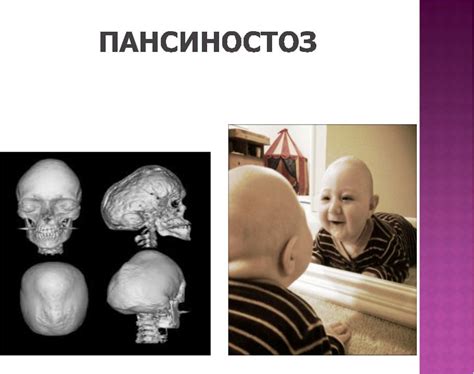Краніостеноз