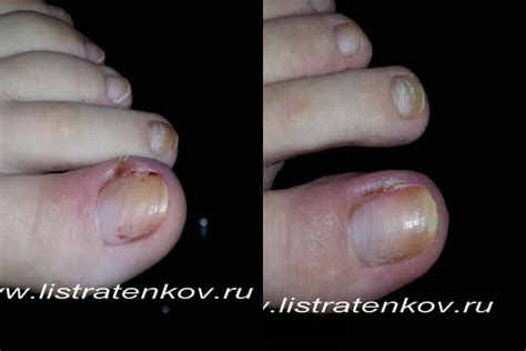 Удаление вросшего ногтя лазером: процедура, цена, фото до и после ...
