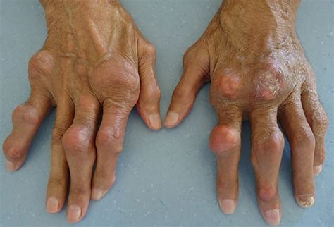 Gout for the Holidays