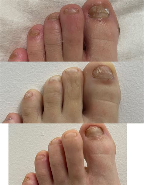Terbinafine Progress 🥲 : r/NailFungus