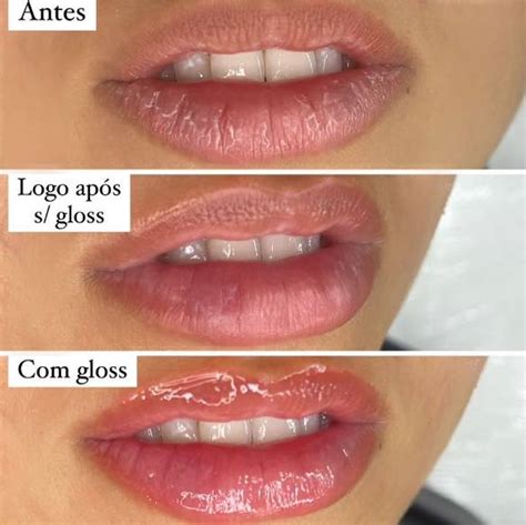 Hydra Gloss Lips Antes E Depois - 6 benefícios do Hydra Gloss para a saúde dos seus lábios
