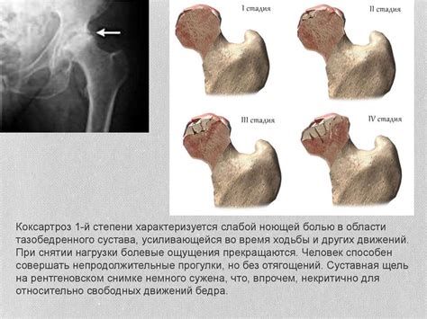 Коксартроз тазобедренного сустава 1 степени: причины, симптомы ...