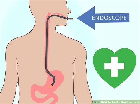 How to Treat a Bleeding Ulcer: 14 Steps (with Pictures) - wikiHow