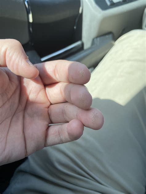 Finger pricks! Am I the only one that uses one hand cause I like to