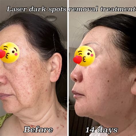 skincare picoway laser removal dark spots treatment located  fresno