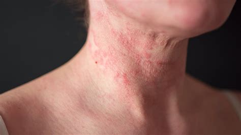 22 Common Skin Rashes: Pictures, Causes, and Treatment