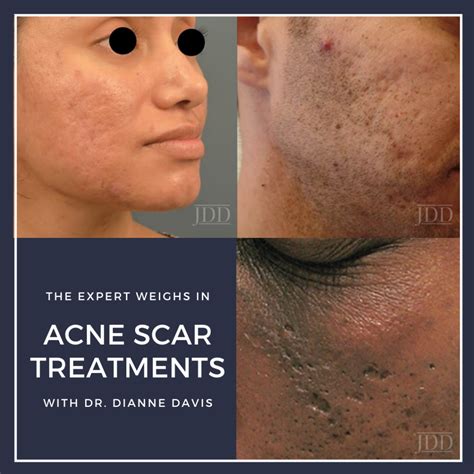 Acne Scar Treatment Watson at Janice Davis blog